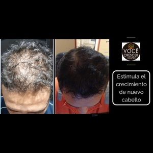 Voce Crescer Accessories Vc Hair Loss Treatment Shampoo 1 Month